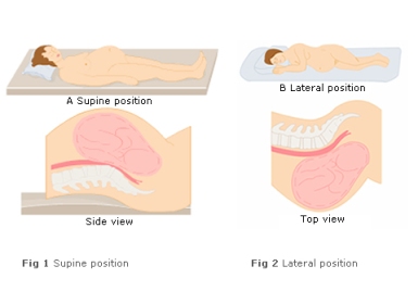 lateral versus supine